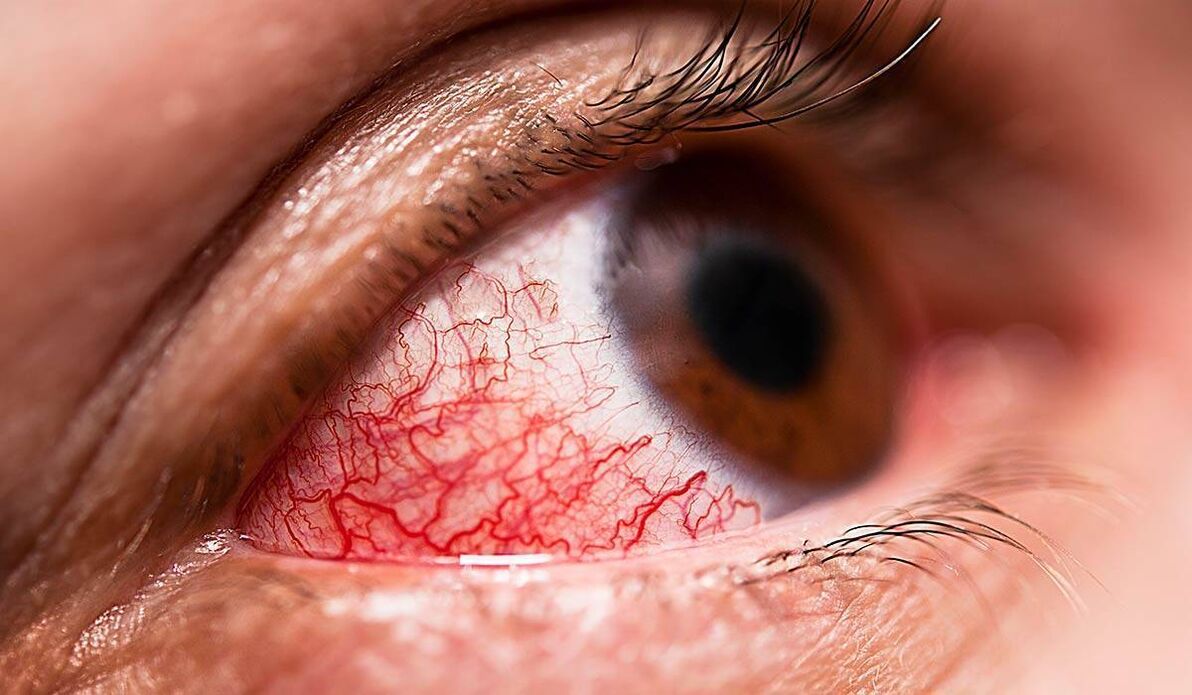 La rétinopathie diabétique est l'une des complications tardives du diabète